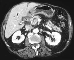 Pseudo clot in the Superior Mesenteric Vein (SMV) on Arterial Phase Images - CTisus CT Scan