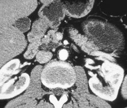 Subtle Cyst Lesion in the Uncinate Process (benign Intraductal Papillary Mucinous Tumor (IPMT)) - CTisus CT Scan