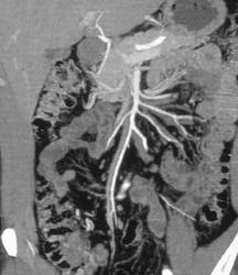 3D of SMA - CTisus CT Scan