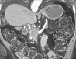 Subtle Pancreatic Cancer - CTisus CT Scan