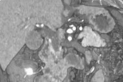 Tumor in Distal Common Bile Duct - CTisus CT Scan