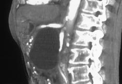 Pseudocyst - CTisus CT Scan