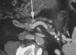 Insulinoma - CTisus CT Scan