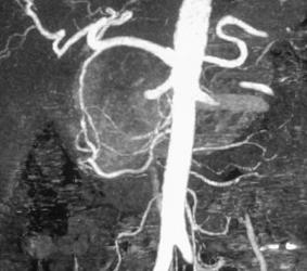 Islet Cell Tumor Invades Gastroduodenal Artery (GDA) and Portal Vein - CTisus CT Scan