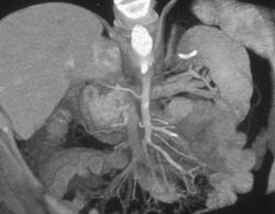 Normal Superior Mesenteric Artery (SMA) With Accessory Right Hepatic Artery - CTisus CT Scan