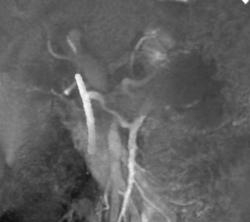 Pancreatic Cancer With Superior Mesenteric Vein (SMV) Invasion - CTisus CT Scan