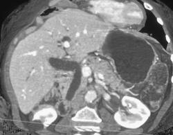 Ct Cholangiogram - CTisus CT Scan