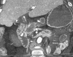 Pancreatic Cancer Invades the Portal Vein - CTisus CT Scan