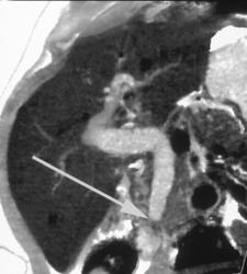 Distal Common Bile Duct (CBD) Tumor With 3D Maps - CTisus CT Scan