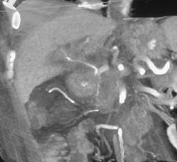 Pancreatic Cancer Invades the Gastroduodenal Artery (GDA) - CTisus CT Scan