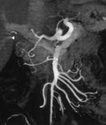 Normal SMA - CTisus CT Scan