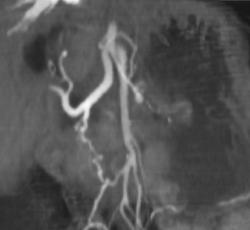 Gastroduodenal Artery (GDA) Invaded By Tumor - CTisus CT Scan