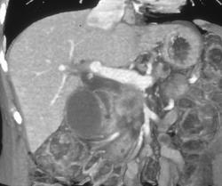 Pancreatic Cancer Occludes the Splenic Vein - CTisus CT Scan