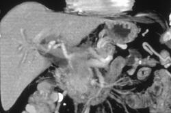 Pancreatic Cancer With Invasion - CTisus CT Scan