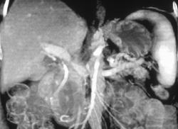 Portal Vein Encased By Tumor - CTisus CT Scan