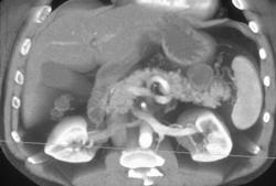 Cystadenoma of the Pancreas - CTisus CT Scan