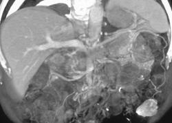 Pancreatic Cancer With Vascular Invasion - CTisus CT Scan