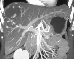 Hemangioma - CTisus CT Scan