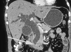 Occluded Distal Common Bile Duct (CBD) By Distal Tumor - CTisus CT Scan