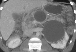 Pancreatic Cysts in Von Hippel Lindau - CTisus CT Scan