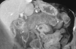 Intraductal Papillary Mucinous Tumor (IPMT) of the Pancreas - CTisus CT Scan