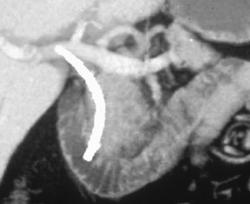 3D of C-loop and Pancreatic Head - CTisus CT Scan