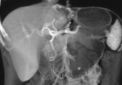 Incidental Hemangioma in Patient With Pancreatic Cancer - CTisus CT Scan