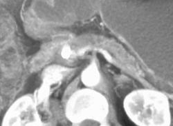 Invasion of Portal Vein By Pancreatic Cancer - CTisus CT Scan