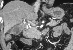 Gallbladder Cancer Presented as A Pancreatic Cancer - CTisus CT Scan