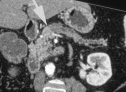 Subtle Pancreatic Cancer (texture Change) - CTisus CT Scan