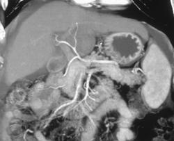 Pancreatic Cancer With Normal Vessels - CTisus CT Scan