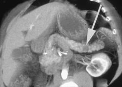 1 Cm Carcinoma of the Pancreatic Tail - CTisus CT Scan