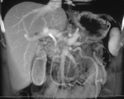 Invasive Pancreatic Cancer With Collaterals - CTisus CT Scan