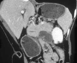 Cystic Tumor of the Pancreatic Tail - CTisus CT Scan