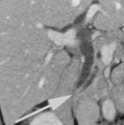 Double Duct Sign - CTisus CT Scan