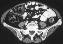 Carcinomatosis From Pancreatic Cancer - CTisus CT Scan