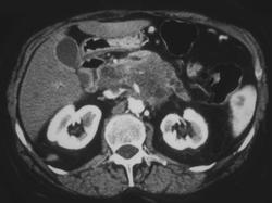 Adenocarcinoma of the Pancreas With Vascular Encasement - CTisus CT Scan