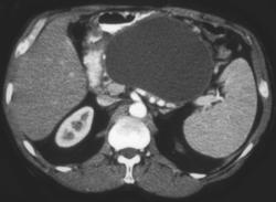 Pseudocyst - CTisus CT Scan