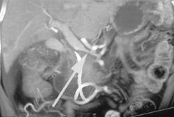 Carcinoma of the Pancreas Encases the Portal Vein - CTisus CT Scan