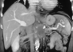 Carcinoma of the Pancreas in 3D - CTisus CT Scan