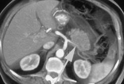 Carcinoma of the Tail of the Pancreas With Early Invasion of the Splenic Artery - CTisus CT Scan