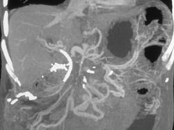 Extensive Collaterals With Pancreatic Cancer Encases the Superior Mesenteric Artery (SMA) and Superior Mesenteric Vein (SMV) - CTisus CT Scan