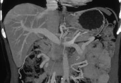 Portal Vein Encased By Pancreatic Cancer - CTisus CT Scan