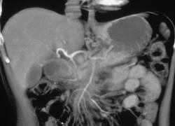 Subtle Invasion of Superior Mesenteric Artery (SMA) By Pancreatic Cancer - CTisus CT Scan