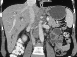 Extensive Nodes From Pancreatic Cancer - CTisus CT Scan