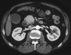 Pancreatic Head Tumor - CTisus CT Scan