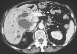 Huge Dilated Ducts Due to Pancreatic Tumor - CTisus CT Scan