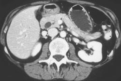 Ampullary Cancer - CTisus CT Scan