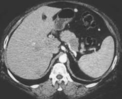 Subtle Carcinoma of the Tail of the Pancreas With Liver Metastases - CTisus CT Scan