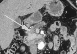 2 Cm Pancreatic Cancer With Dilated Pancreatic Duct - CTisus CT Scan